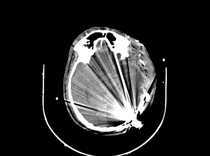 File:Brain injury by firearm projectile (Radiopaedia 82068-96087 B 96).jpg