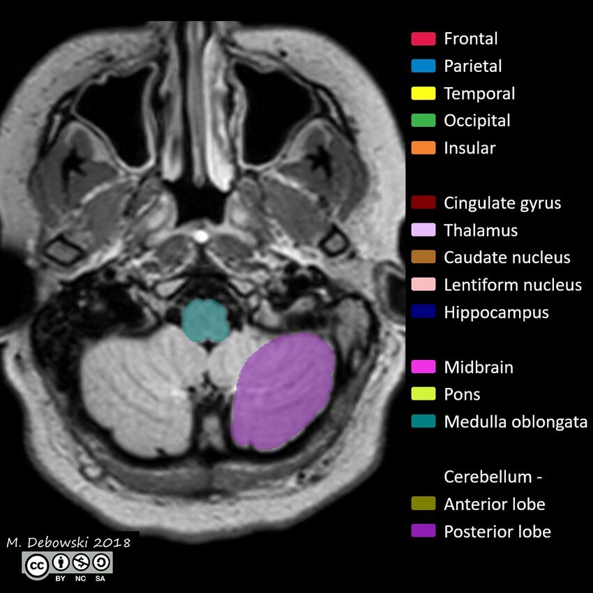 Brain lobes - annotated MRI (Radiopaedia 61691-69700 Axial 71).JPG