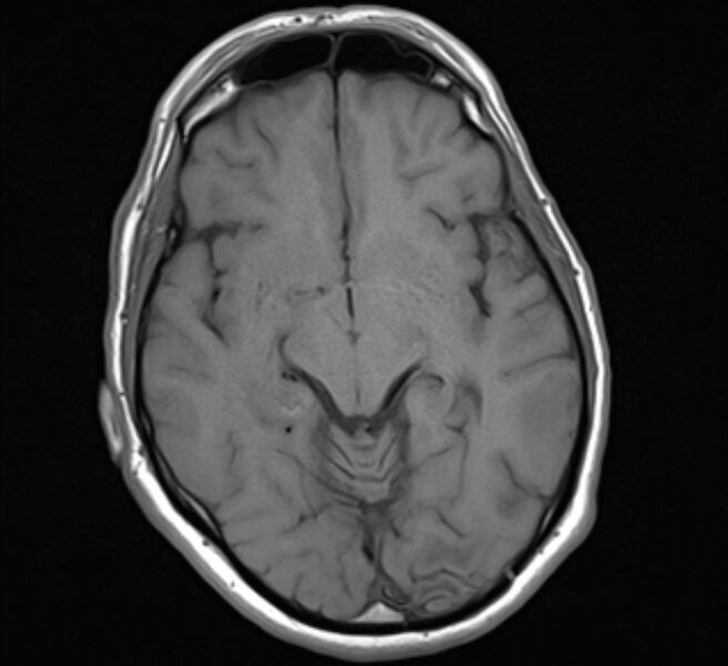 File:Brain metastases - lung cancer primary (Radiopaedia 75060-86115 Axial T1 12).jpg