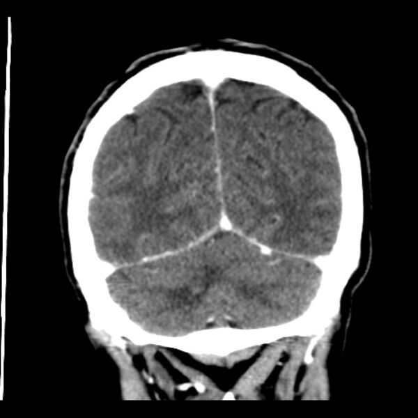File:Brain metastases from lung cancer (Radiopaedia 24480-24781 Coronal C+ delayed 51).jpg