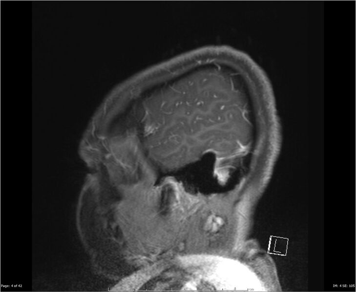 File:Brainstem glioma (Radiopaedia 21819-21775 D 4).jpg