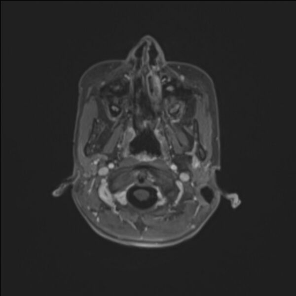 File:Brainstem glioma (Radiopaedia 70548-80674 Axial T1 C+ 16).jpg