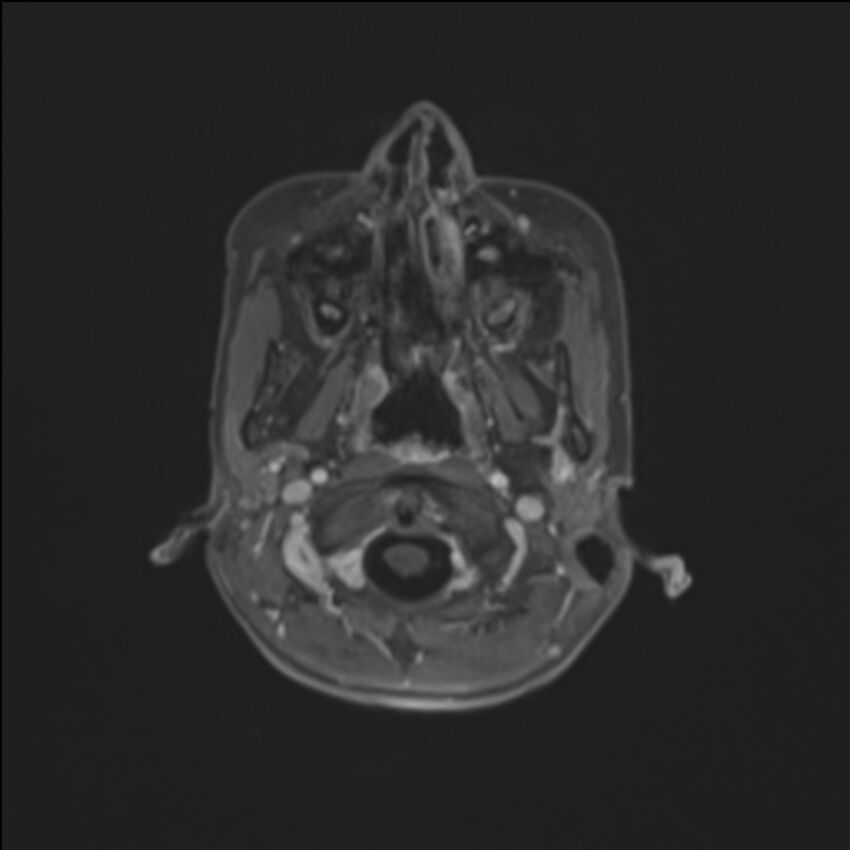 Brainstem glioma (Radiopaedia 70548-80674 Axial T1 C+ 16).jpg