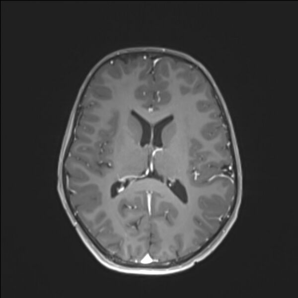 File:Brainstem glioma (Radiopaedia 70548-80674 Axial T1 C+ 93).jpg