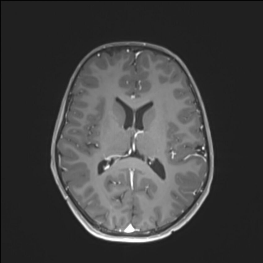 Brainstem glioma (Radiopaedia 70548-80674 Axial T1 C+ 93).jpg