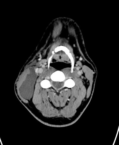 File:Branchial cleft cyst (Radiopaedia 31167-31875 Axial C+ delayed 29).jpg