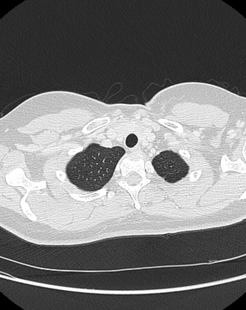 Bronchial atresia (Radiopaedia 50007-55297 Axial lung window 6).jpg