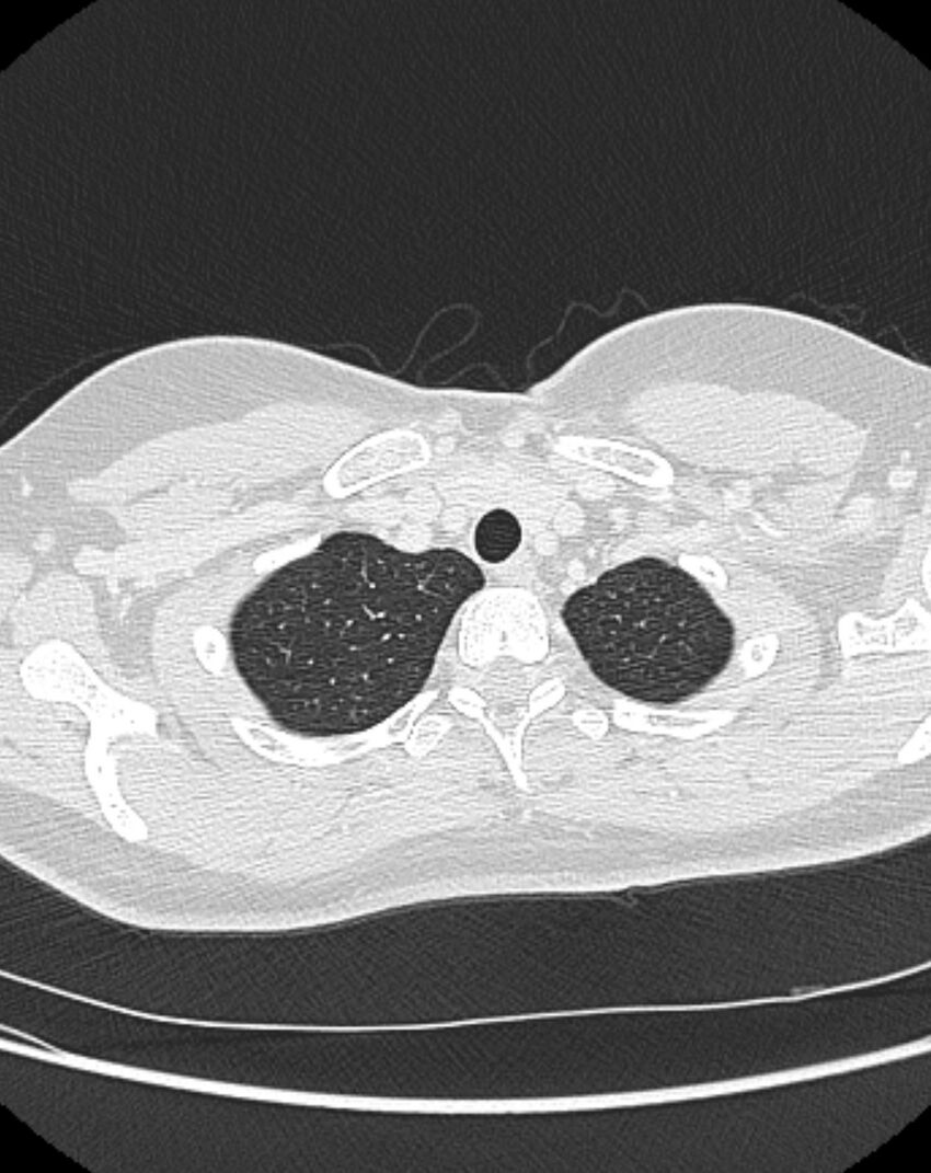 Bronchial atresia (Radiopaedia 50007-55297 Axial lung window 8).jpg