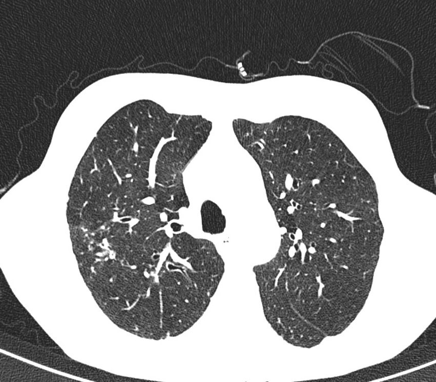 Bronchiolitis (Radiopaedia 24616-24887 Axial lung window 15).jpg