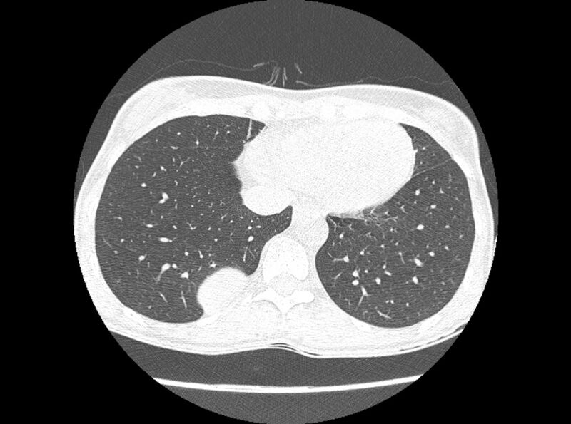File:Bronchogenic cyst (Radiopaedia 80273-93615 Axial lung window 10).jpg