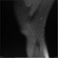 Bucket handle tear - lateral meniscus (Radiopaedia 7246-8187 Sagittal T2 fat sat 3).jpg