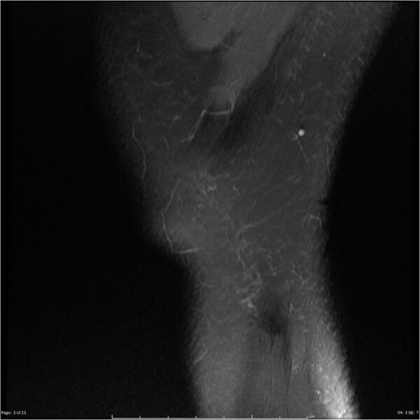 File:Bucket handle tear - lateral meniscus (Radiopaedia 7246-8187 Sagittal T2 fat sat 3).jpg
