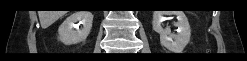 File:Buried bumper syndrome - gastrostomy tube (Radiopaedia 63843-72575 Coronal 42).jpg