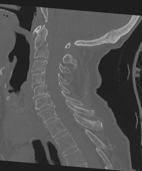 File:C2 fracture with vertebral artery dissection (Radiopaedia 37378-39199 Sagittal bone window 40).png