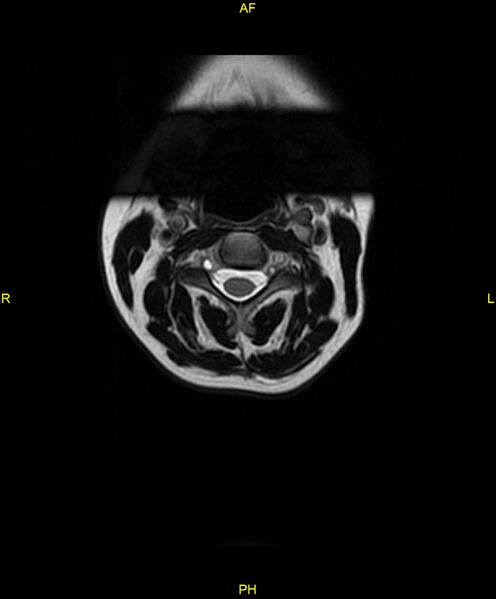 File:C5 nerve sheath tumor (Radiopaedia 85777-101596 Axial T2 6).jpg