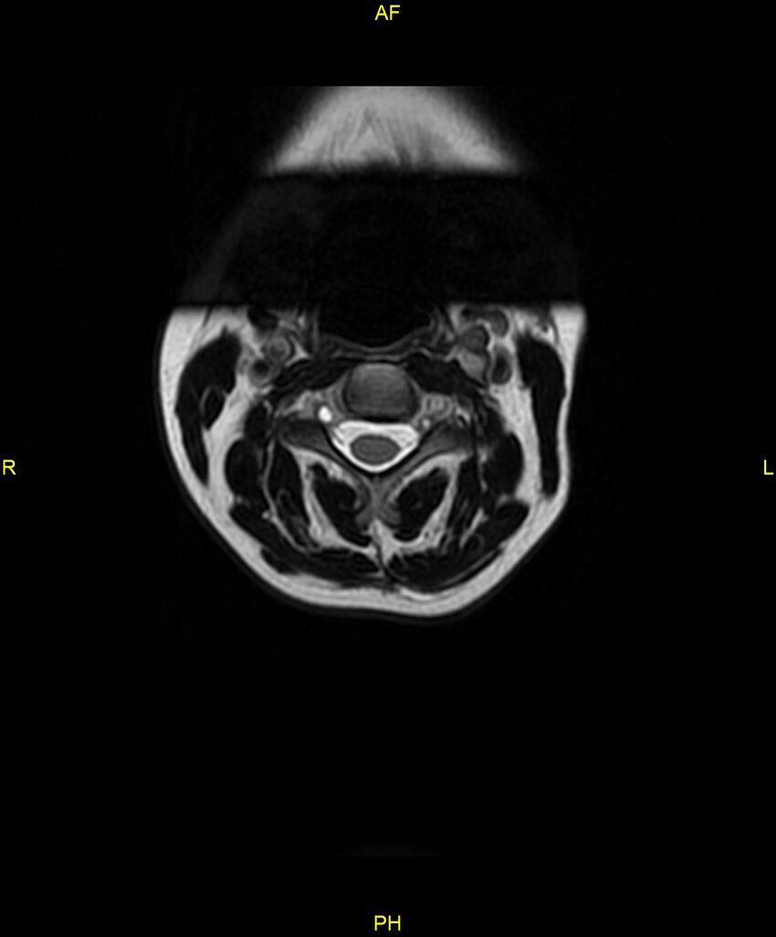 C5 nerve sheath tumor (Radiopaedia 85777-101596 Axial T2 6).jpg