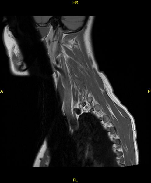 File:C5 nerve sheath tumor (Radiopaedia 85777-101596 Sagittal T1 4).jpg