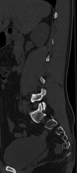 File:Calcaneal fractures with associated L2 burst fracture (Radiopaedia 71671-82493 Sagittal bone window 61).jpg