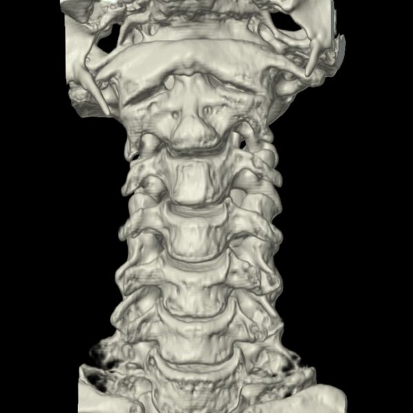 File:Calcified meningioma - cervical canal (Radiopaedia 70136-80171 3D-VR 1).jpg