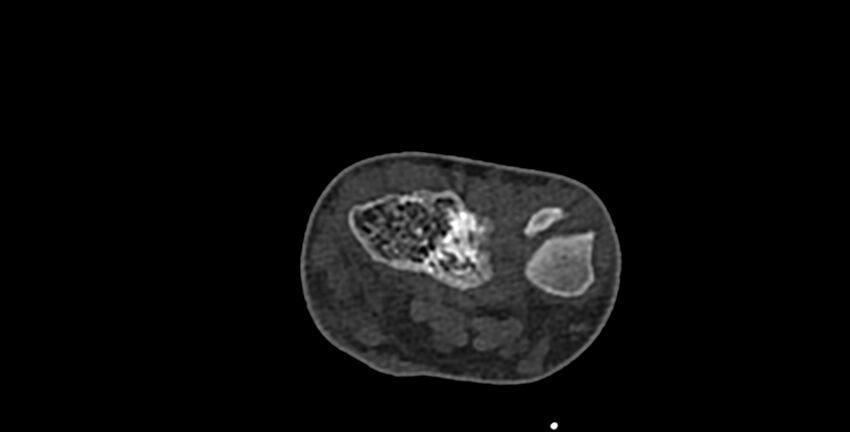 Calcifying aponeurotic fibroma (Radiopaedia 88423-105064 Axial bone window 31).jpg