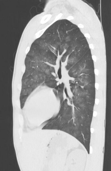 File:Cannabis-induced diffuse alveolar hemorrhage (Radiopaedia 89834-106946 Sagittal lung window 97).jpg