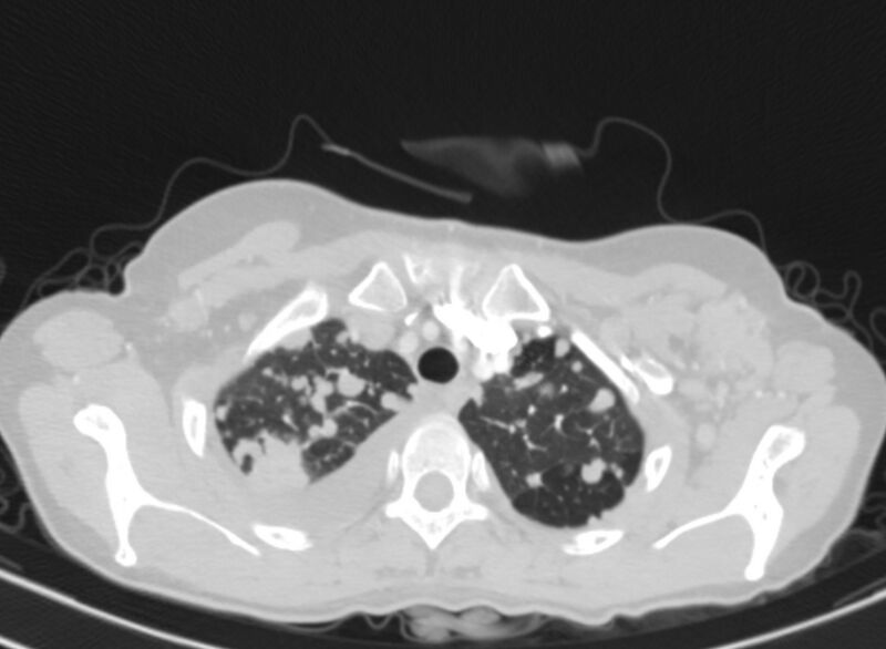 File:Cannonball metastases from breast cancer (Radiopaedia 91024-108569 Axial lung window 12).jpg