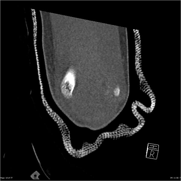 File:Capitellum fracture (Radiopaedia 23352-23426 Coronal bone window 10).jpg