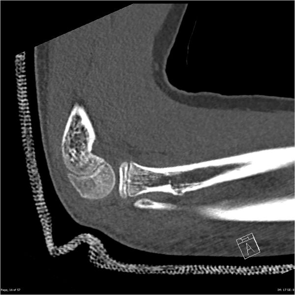 File:Capitellum fracture (Radiopaedia 23352-23426 Sagittal bone window 16).jpg