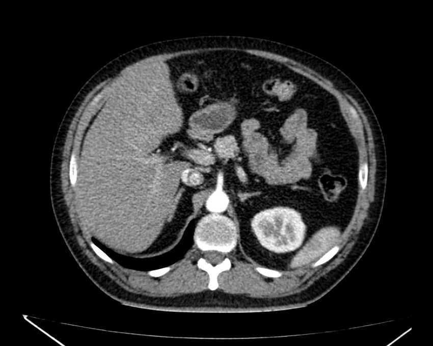 Carcinoid tumor with hepatic metastases (Radiopaedia 22651-22670 B 26).jpg