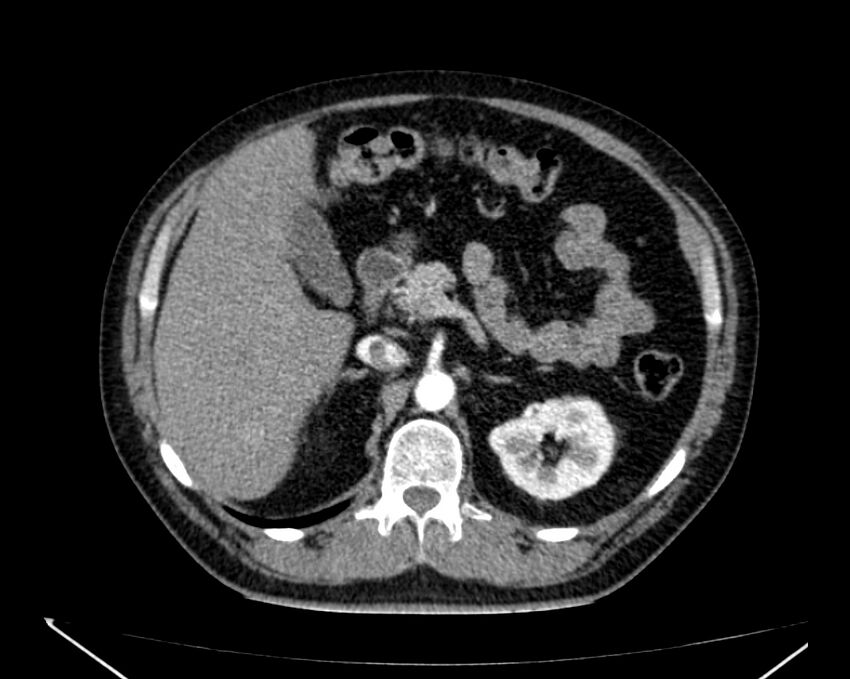 Carcinoid tumor with hepatic metastases (Radiopaedia 22651-22670 B 29).jpg