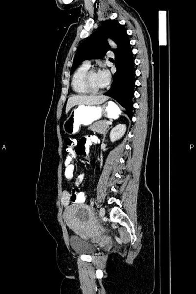 File:Carcinoma of uterine cervix (Radiopaedia 85861-101700 D 52).jpg