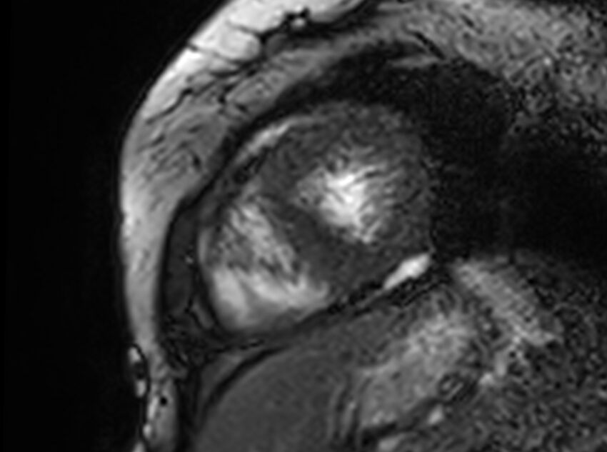 Cardiac amyloidosis (Radiopaedia 61600-69579 Short axis bSSFP 62).jpg