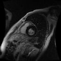 Cardiac fibroma (Radiopaedia 38974-41150 C 8).jpg