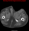 Cardiac perforation following transcatheter aortic valve implantation (Radiopaedia 23714-23863 B 22).png