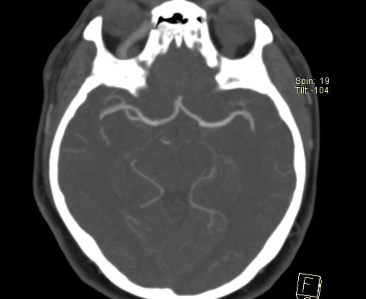 File:Caroticocavernous fistula (Radiopaedia 29565-30069 Axial MIP 20).jpg