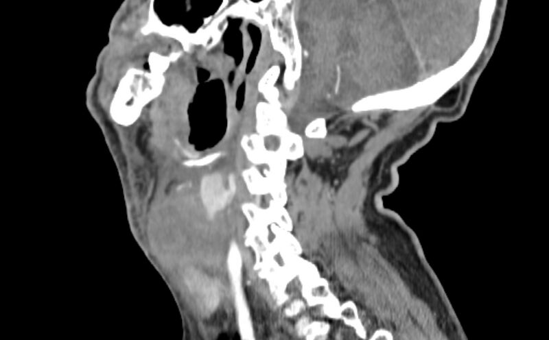 File:Carotid artery pseudoaneurysm (Radiopaedia 84030-99259 E 17).jpg