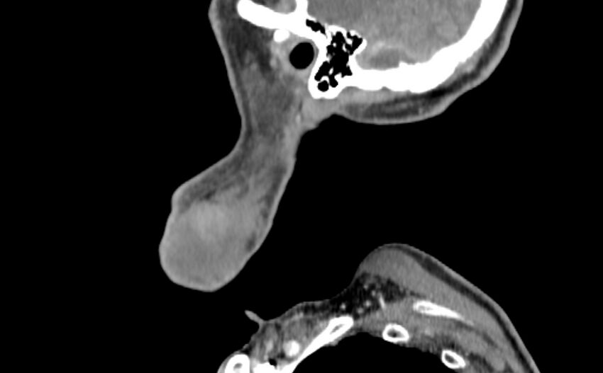 Carotid artery pseudoaneurysm (Radiopaedia 84030-99259 E 62).jpg