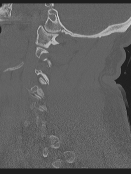 File:Cavernoma of cervical cord (Radiopaedia 50838-56346 Sagittal bone window 25).png