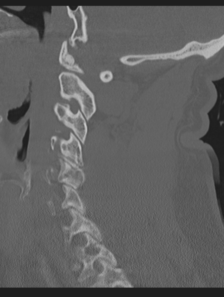 File:Cavernoma of cervical cord (Radiopaedia 50838-56346 Sagittal bone window 32).png