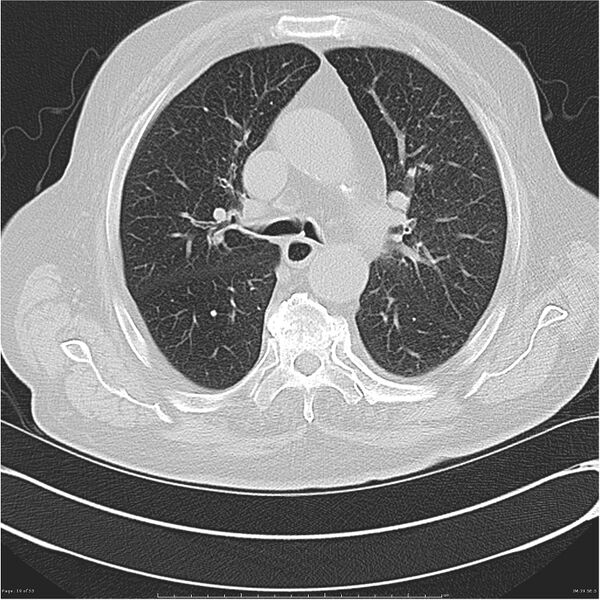File:Cavitating left lower lobe lesion - squamous cell lung cancer (Radiopaedia 27749-28176 Axial lung window 19).jpg
