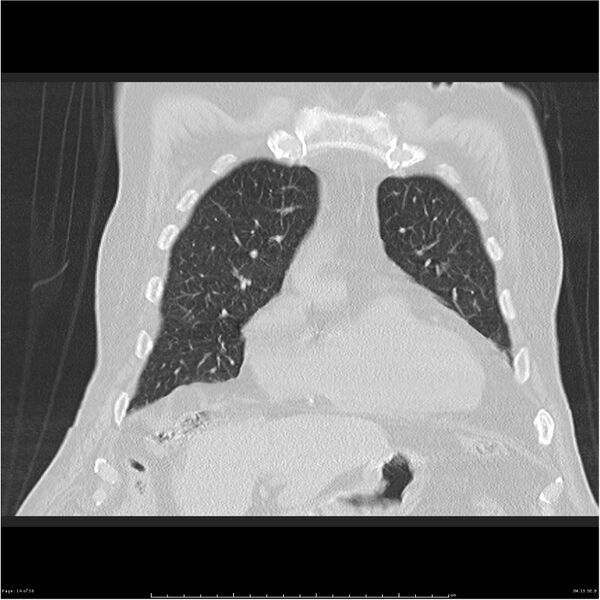 File:Cavitating left lower lobe lesion - squamous cell lung cancer (Radiopaedia 27749-28176 Coronal lung window 14).jpg