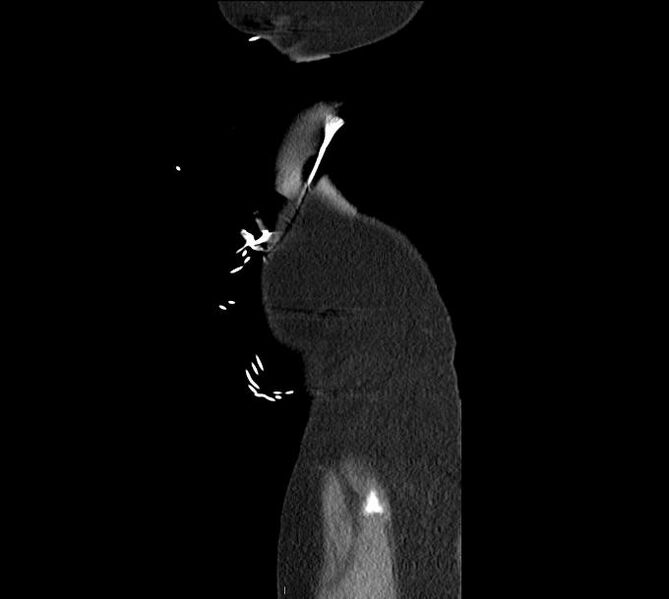 File:Celiac artery severe stenosis and dissection (Radiopaedia 44128-47842 A 1).jpg