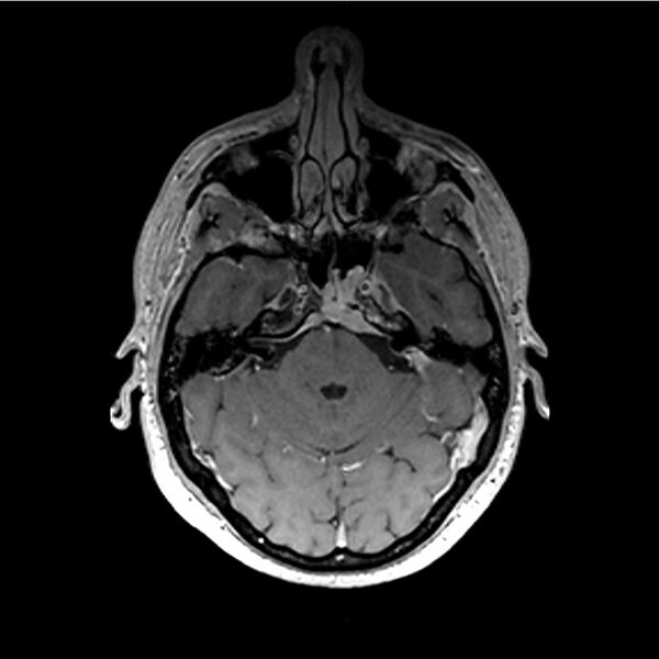 File:Central base of skull meningioma (Radiopaedia 53531-59549 Axial T1 C+ 9).jpg