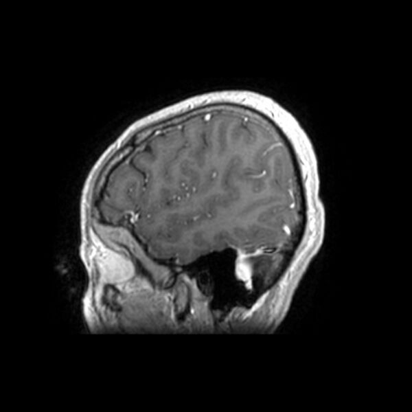 File:Central neurocytoma (Radiopaedia 67618-77021 Sagittal T1 C+ 4).jpg