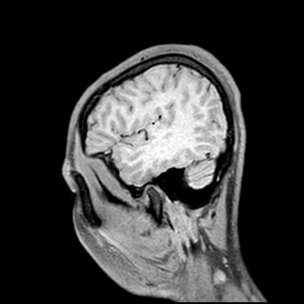 File:Central neurocytoma (Radiopaedia 79320-92380 Sagittal T1 212).jpg