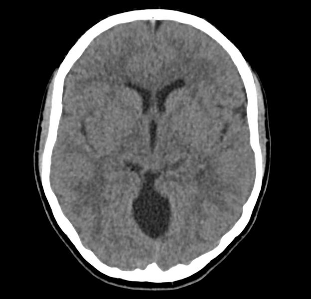 File:Cerebellar agenesis (Radiopaedia 30203-30817 Axial non-contrast 20).jpg