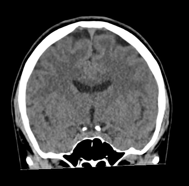 File:Cerebellar agenesis (Radiopaedia 30203-30817 Coronal non-contrast 14).jpg