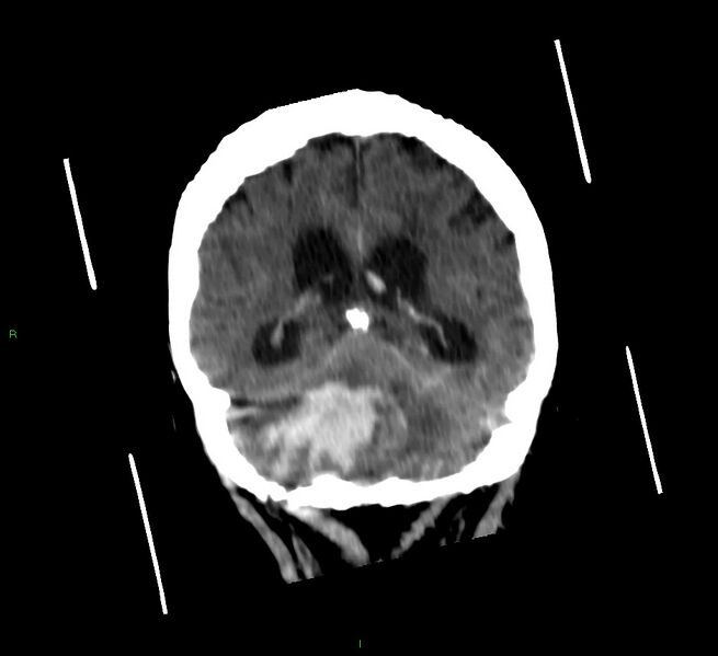 File:Cerebellar hemorrhage (Radiopaedia 58792-66026 Coronal non-contrast 26).jpg