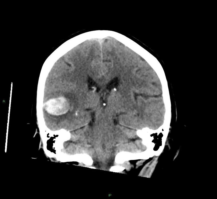 Cerebral amyloid angiopathy-associated lobar intracerebral hemorrhage (Radiopaedia 58378-65516 Coronal non-contrast 27).jpg