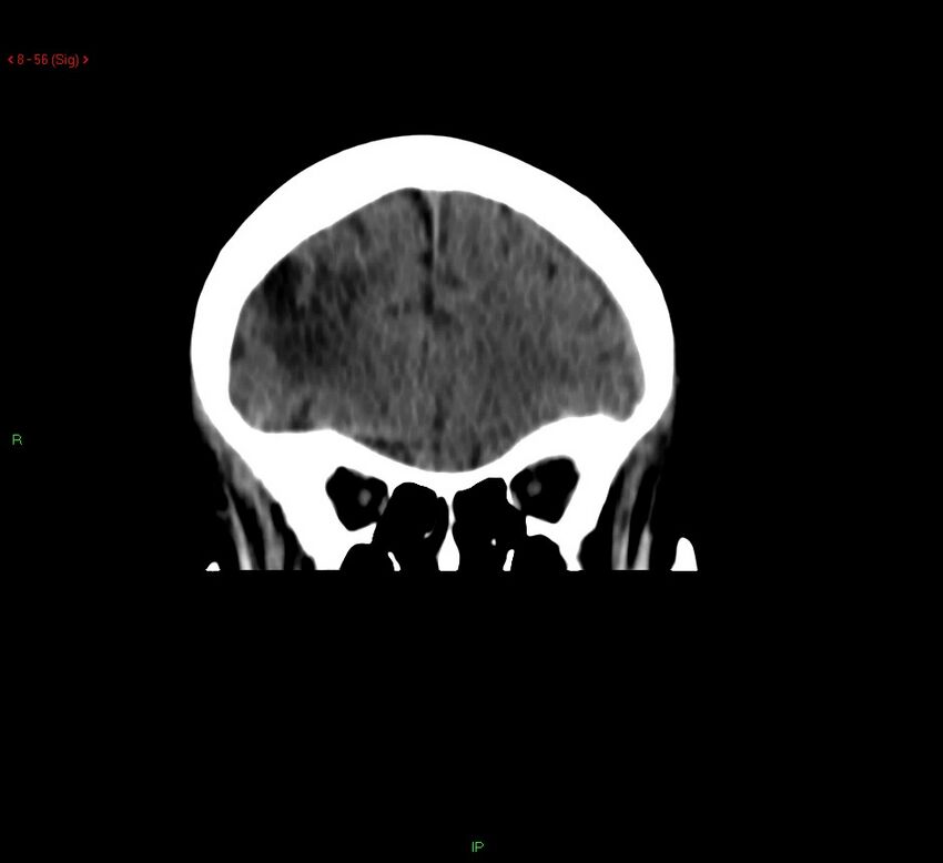 Cerebral amyloid angiopathy-associated lobar intracerebral hemorrhage (Radiopaedia 58378-65518 Coronal non-contrast 56).jpg